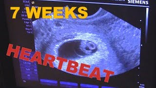 7 weeks 0 days Pregnant ULTRASOUND amp Babys HEARTBEAT ❤️ Early Pregnancy USG  AMAZING [upl. by Aneertak66]