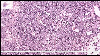 Hemangiomas  capillary and cavernous  Histopathology slides [upl. by Esorylime126]