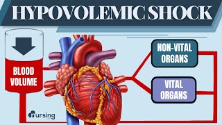 Hypovolemic Shock  Patho and Treatment Nursing [upl. by Annig]