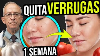 🧄 ELIMINA VERRUGAS Con Estos INGREDIENTES Y Tratamientos  Oswaldo Restrepo RSC [upl. by Roleat]