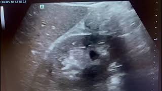 Angiomyolipoma in kidney on ultrasound radiologyViralcommonusgultrasoundrenalkidneydisease [upl. by Nojram]