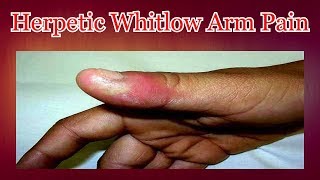 Herpetic Whitlow Arm Pain [upl. by Narag521]