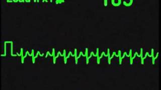 Supraventricular Tachycardia  SVT  ECG Simulator  Arrhythmia Simulator [upl. by Weihs507]