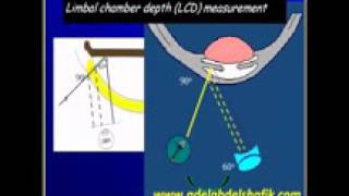 Gonioscopy Lecture part 08 YouTube [upl. by Amand768]