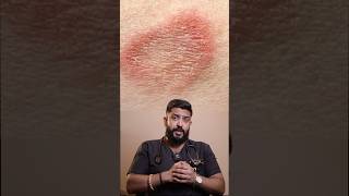 Ringworm infection drprashantharun [upl. by Adnylg]