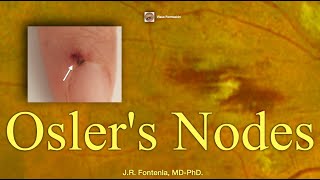 Oslers Nodes Bacterial Endocarditis [upl. by Chisholm431]