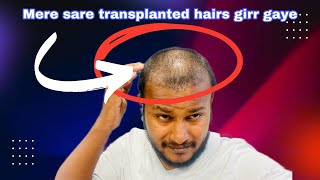 Hair shedding and 20th day update after my hair transplant surgery [upl. by Yvehc]