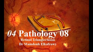 04 Retinal Pathology 08 Elkafrawy pathology باثولوجيالكفراوي Idiopathic telangiectasia ampLebers [upl. by Atsok]