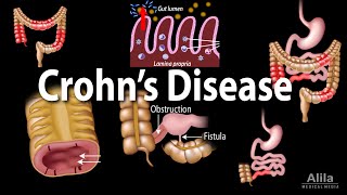 Crohns Disease Pathophysiology Symptoms Risk factors Diagnosis and Treatments Animation [upl. by Anul]