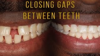 Closing Gaps Between Teeth With Braces [upl. by Ydospahr]