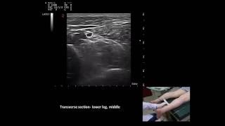 Ultrasound guided m tibialis posterior botulinum toxin injection by Murat Karkucak MD [upl. by Cilla]