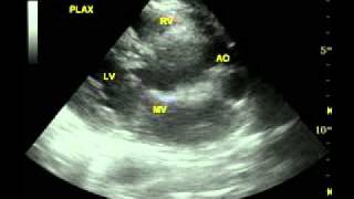 Normal parasternal long axis PLAX echowmv [upl. by Aleet949]