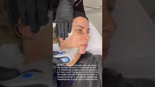 Aplicação UltramedUltraformer facial  Ultrassom microfocado [upl. by Leal]