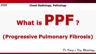 PPF progressive pulmonary fibrosis [upl. by Whang276]