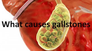 What causes gallstones and the thyroid hormone connection [upl. by Ardeha783]