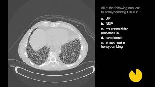 26 Cases of Interstitial Lung Disease  Xrays amp CT Scans [upl. by Lleon745]