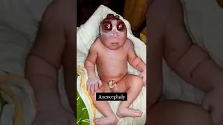 Anencephaly youtubeshorts viral newborn paediatrics birth medical trending doctor obgyn kb [upl. by Ahsram]