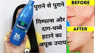 WINTER SPECIAL PIMPLE REMOVAL  Remove Pimples Acne Pimple Marks completely  ThatGlamGirl [upl. by Kirimia]