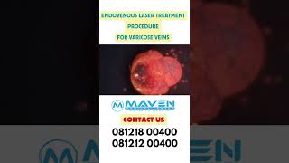 Most Demanding Endovenous Laser Treatment Procedure [upl. by Ellertnom]