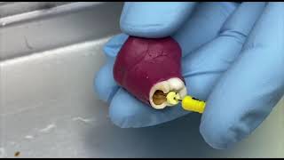 Paediatric Dentistry  Pulpectomy Demo Video [upl. by Graehme]