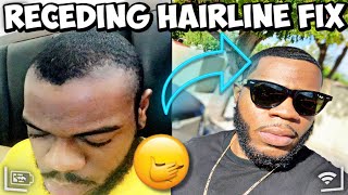 HOW TO FIX A RECEDING  THINNING HAIRLINE  IN 30 DAYS  😱😱🤯 [upl. by Nassir]