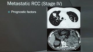 Renal Cell Carcinoma [upl. by Phene]