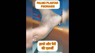 PALMOPLANTAR PSORIASIS psoriasis itching dryskin shortsfeed shortvideo shorts ytviral SHORT [upl. by Indira284]