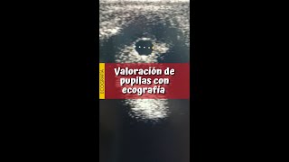 VALORACIÓN PUPILAR 👁️ CON ECOGRAFÍA todo lo que necesitas saber en un solo vídeo [upl. by Gesner]