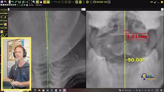 Frontal film analysis AdvO style with Dr Collins [upl. by Ogilvy]