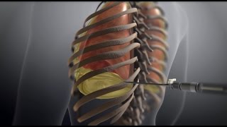 Thoracentesis [upl. by Mcmillan]