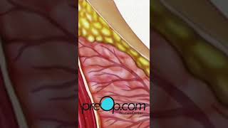 PreOp® 🎗️ Your Guide to Incisional Breast Biopsy preop shorts health 🩺 [upl. by Susan767]