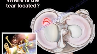 Knee Pain  Meniscus tear  Everything You Need To Know  Dr Nabil Ebraheim [upl. by Nnylakcaj]