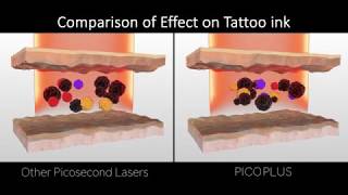 Luntronic PICOPLUS Laser FDA approved Picosecond amp Nanosecond Platform [upl. by Enomad]