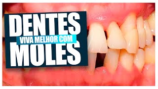 Se você tem Dentes Moles PERIODONTITE você precisa assistir esse video [upl. by White]