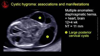 Cystic hydroma and nuchal edema at 1113 weeks of pregnancy [upl. by Ainnat]