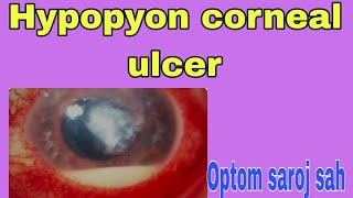 Hypopyon corneal ulcer [upl. by Valentijn]