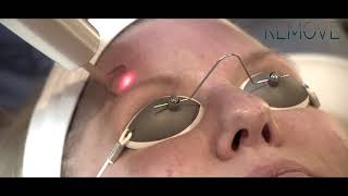 Picotoning  skin rejuvenation with PicoWay laser [upl. by Atteloj]