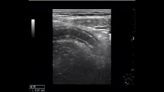 Case1 Appendicitis sonography ultrasound  충수염 초음파 진단사례1 [upl. by Sukey]