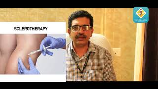 Varicose Veins Treatment│Malayalam Health Tips│Pushpagiri Medical College [upl. by Adiv]