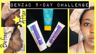 I TRIED BENZOYL PEROXIDE BENZAC AC5 FOR A WEEK BENZOYL PEROXIDE REVIEW BENZOYL PEROXIDE FOR ACNE [upl. by Arela458]