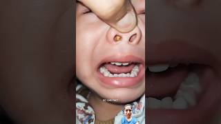 Something Stuck In Nose😵 How Doctor Remove it shots viral [upl. by Bettzel]