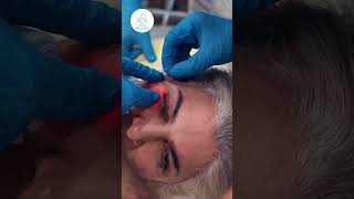 Eyelid Lift with Endolaser eyelidlift [upl. by Nytsirt413]