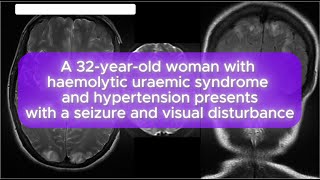 Case 123 A 32yearold woman with haemolytic uraemic syndrome and hypertension [upl. by Sewellyn]