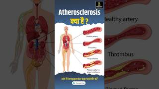 Atherosclerosis के क्या है  Causes sign and symptoms atherosclerosis testpaperlive shorts [upl. by Langbehn276]