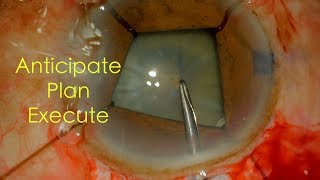 Manual SICS with Iris Retractors in an eye with Pseudoexfoliation ampLoose Zonules Dr Deepak Megur [upl. by Atok]