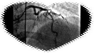 Kateterisasi jantung stent [upl. by Seidnac]