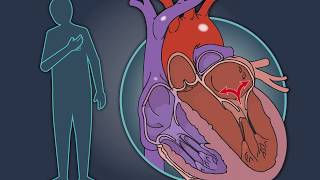 MitralValve Repair in Heart Failure [upl. by Mcspadden]