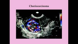 Malignant Gestational Trophoblastic Disease  CRASH Medical Review Series [upl. by Asenab]