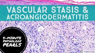 PseudoKaposi sarcoma Acroangiodermatitis aka Severe Stasis 5Minute Pathology Pearls [upl. by Bradan]