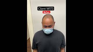 Client m173 before Micro hair tattooing smp scalpmicropigmentation edmonton [upl. by Annek]